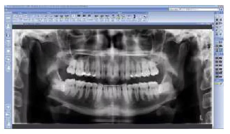 Planmeca SmartPan 2D модуль