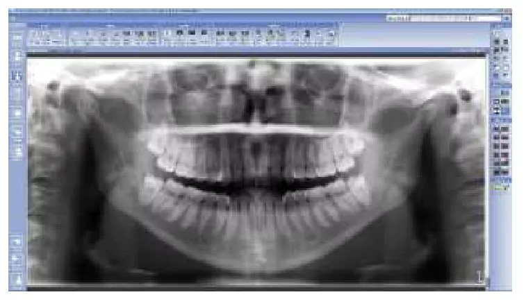 Planmeca SmartPan 3D модуль